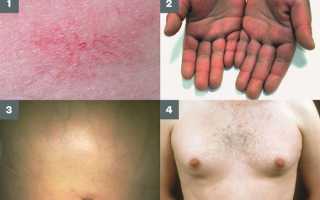 Признаки цирроза печени, симптомы и способы лечения