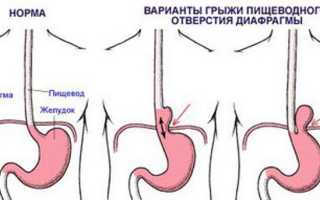 Схема лечения гастрита, дуоденита, язвы и других болезней ЖКТ