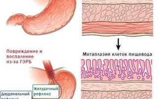 Что такое пищевод Барретта и можно ли его вылечить