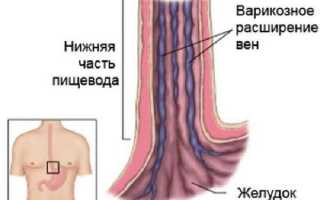 Флебэктазия (варикоз) пищевода: причины, лечение и как избежать болезни