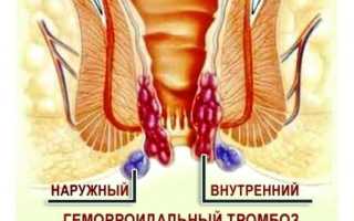 Траумель при геморрое: отзывы о применении мази и геля