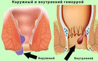 Лечение геморроя соком алоэ – 6 рецептов, противопоказания