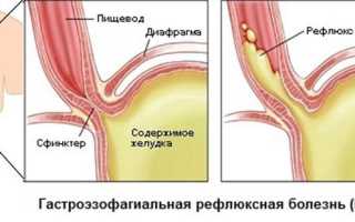 Гастроэзофагеальная рефлюксная болезнь у детей: отечественный рабочий протокол 2013 года